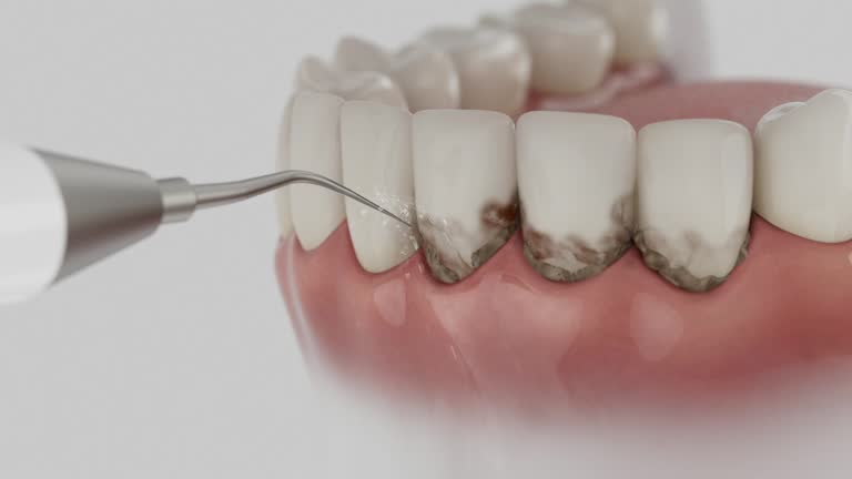 Reliable Dental Implants contractor in South Pasadena, FL by Smile Center Dentistry